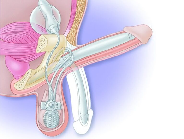 penile prosthesis to increase strength after 60s