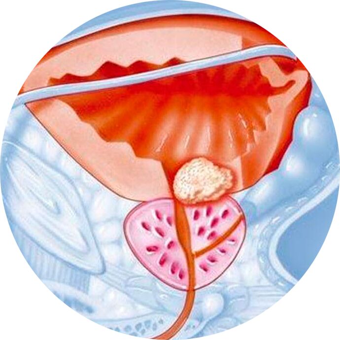 prostate adenoma